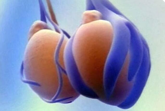 دوالي الخصية